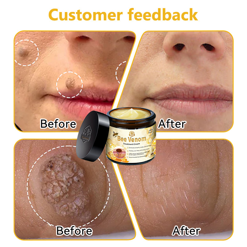 Turonu™ Bee Venom Skin Treatment Cream👨‍⚕[🐝𝐎𝐟𝐟𝐢𝐜𝐢𝐚𝐥 𝐁𝐫𝐚𝐧𝐝 𝐒𝐭𝐨𝐫𝐞🐝](👨‍⚕Suitable for all skin types - Last 30 mins 80% off)