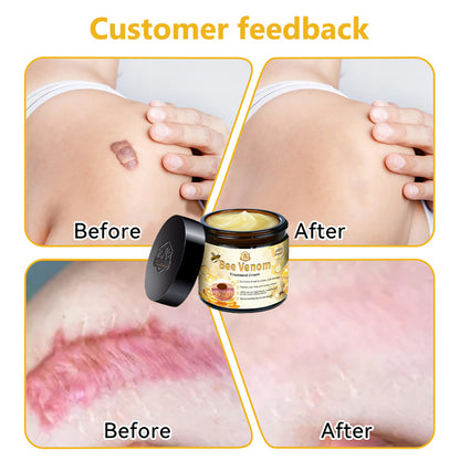 Turonu™ Bee Venom Skin Treatment Cream👨‍⚕[🐝𝐎𝐟𝐟𝐢𝐜𝐢𝐚𝐥 𝐁𝐫𝐚𝐧𝐝 𝐒𝐭𝐨𝐫𝐞🐝](👨‍⚕Suitable for all skin types - Last 30 mins 80% off)